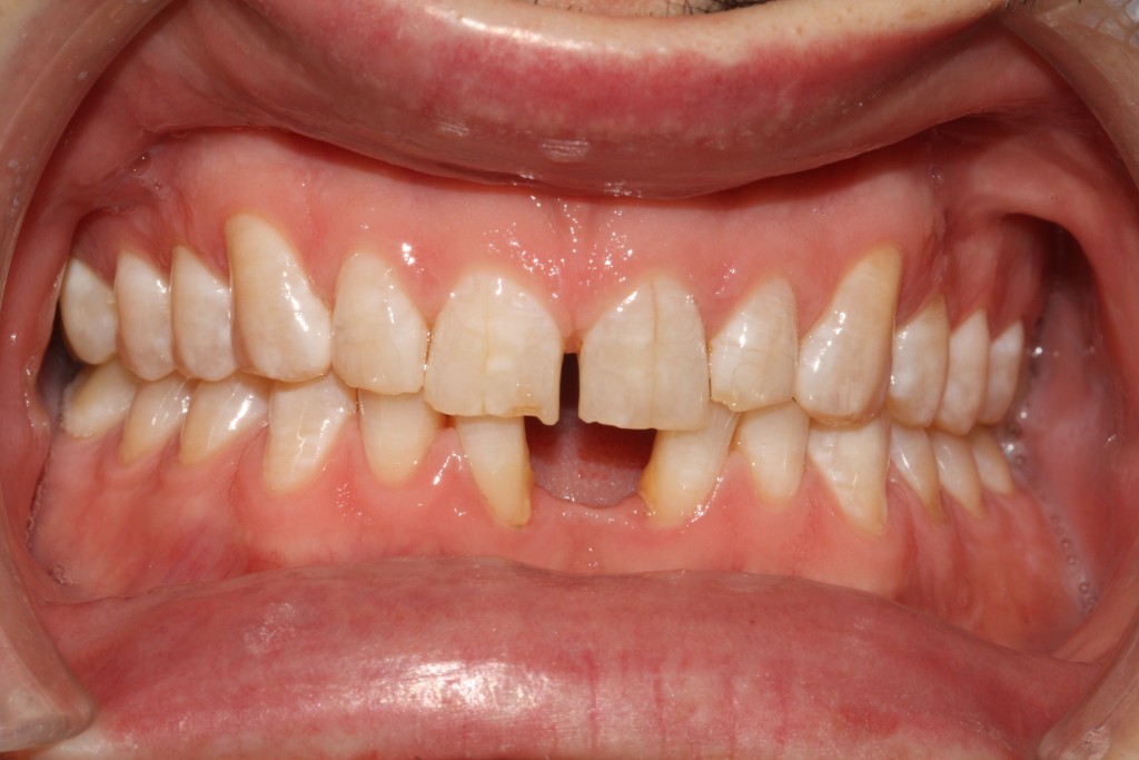 Before & After Smile Gallery Essex | Street Farm Dental