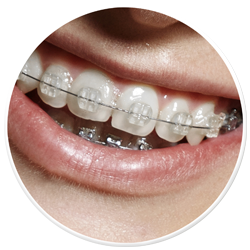 Fixed Braces Essex, Braces for adults